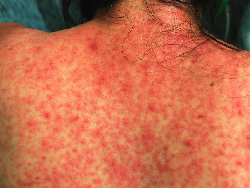 Best Hair Removal Method for Sensitive Skin: Expert Guide 2026